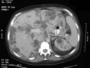 Polycystic Kidney Disease Ultrasound