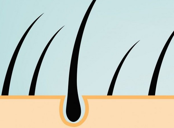 Non-Invasive Screening Tool for Alport Syndrome