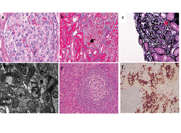 Targeting VEGF and IL-6 in Castleman’s Disease with Renal Involvement