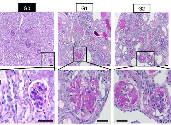 APOL1 Gene Variants are Causal Factors of Kidney Disease in African Americans