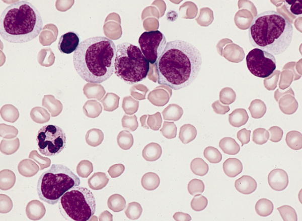 CJASN Podcast Hosts Dr. Tingting Li and Co-authors to Discuss Monocyte Count and CKD Publication