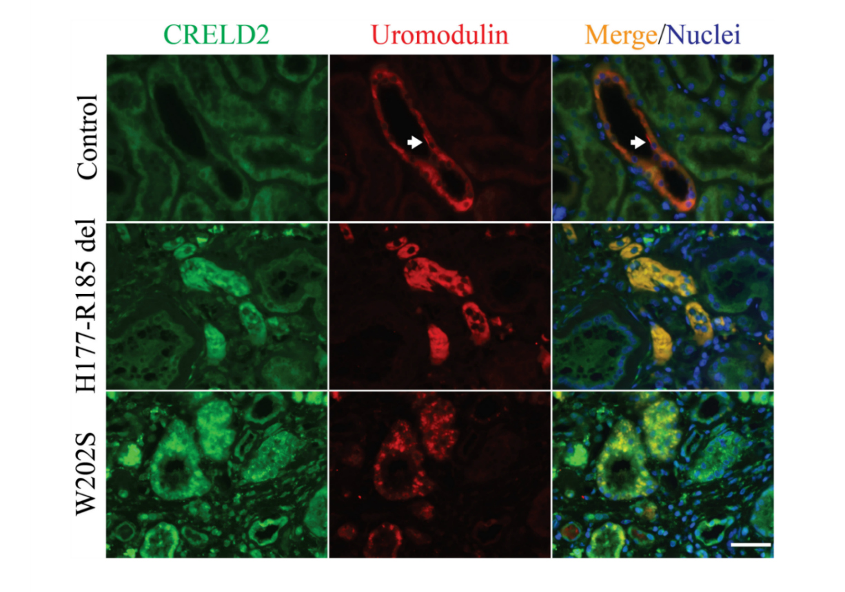 Broad Clinical Applications for CRELD2 as an ER Stress Biomarker