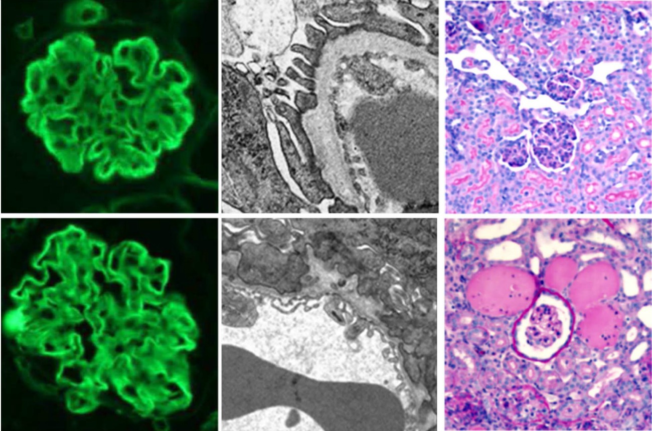 New Study Provides Insight for Variability in the Severity of Alport Syndrome