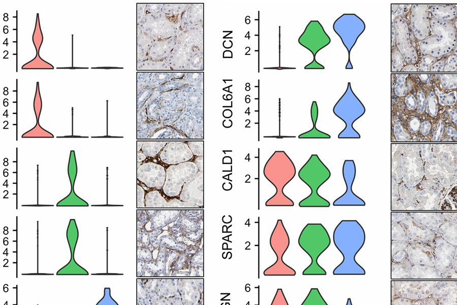 scRNA-seq is a Game Changer in Kidney Biopsy Cell Characterization