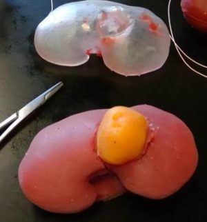 Silicone kidney with exophytic tumor (bottom) formed using 3D printed mold; one piece of the mold (top); WU