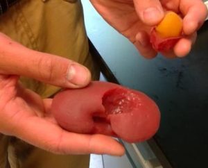 Silicone kidney formed from 3D printed mold, with tumor "excised"; WU